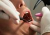 What Are the Best Options to Replace Missing Teeth